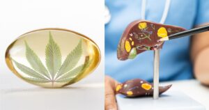 Split image showing a translucent golden-yellow capsule with a green cannabis leaf inside on the left, symbolizing CBD and CBG products. The right side features a medical model of a human liver, with highlighted structures in yellow, brown, and green. A person in blue medical attire points to the liver model with a pen, suggesting a focus on liver health. Keywords: CBD and CBG for liver disease